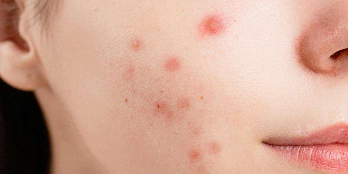 Acne Isn’t Just for Teenagers — Let’s Talk Breakouts, Causes, and Real Solutions <br>___________________________________