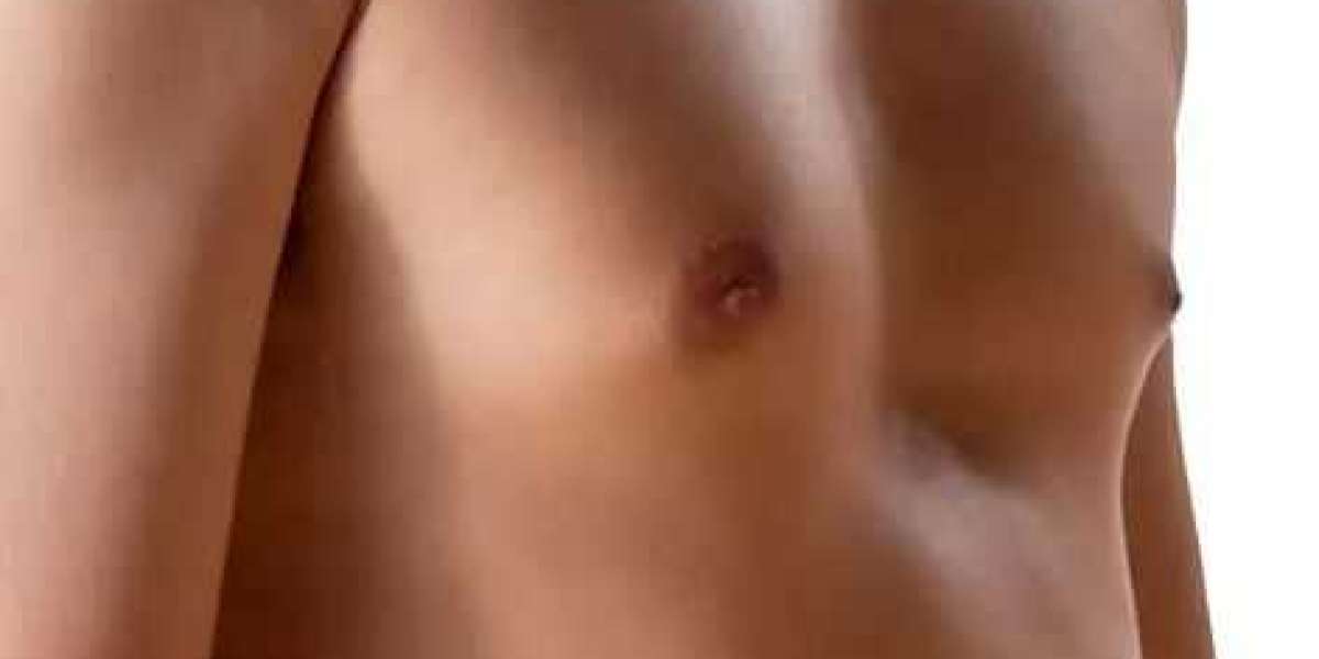 Gynecomastia Male Breast Enlargement: Causes, Symptoms, Treatments, and How to Restore Confidence