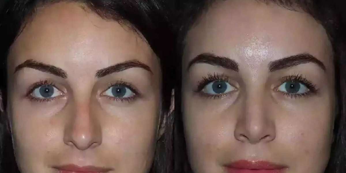 Best Doctors in Dubai for Rhinoplasty Revealed