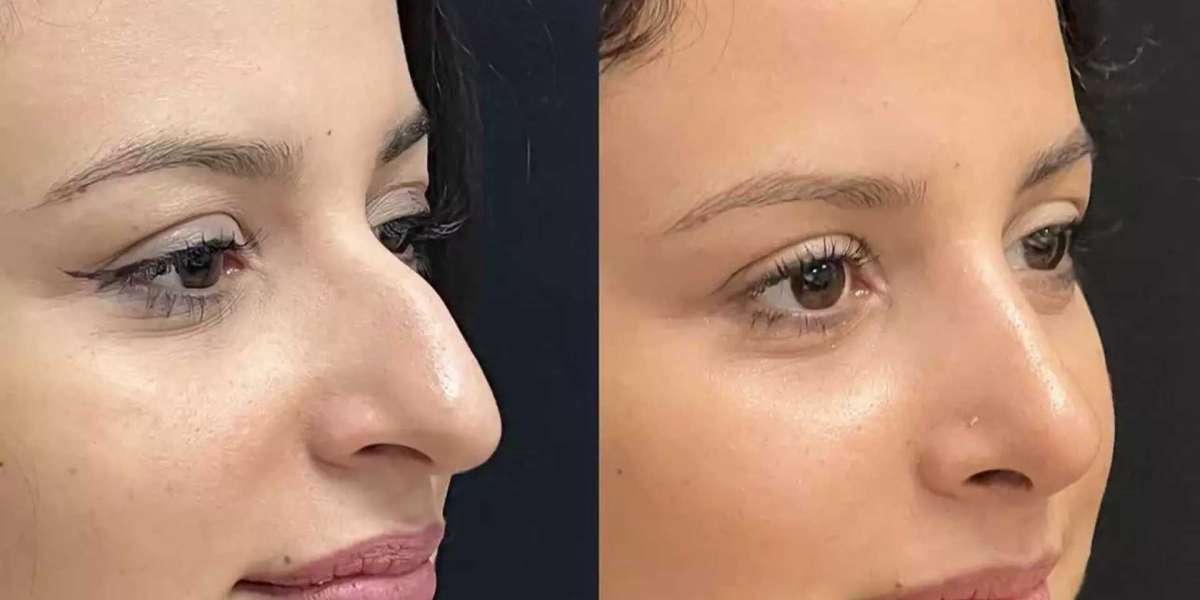 Affordable Nose Surgery in Dubai: What to Know