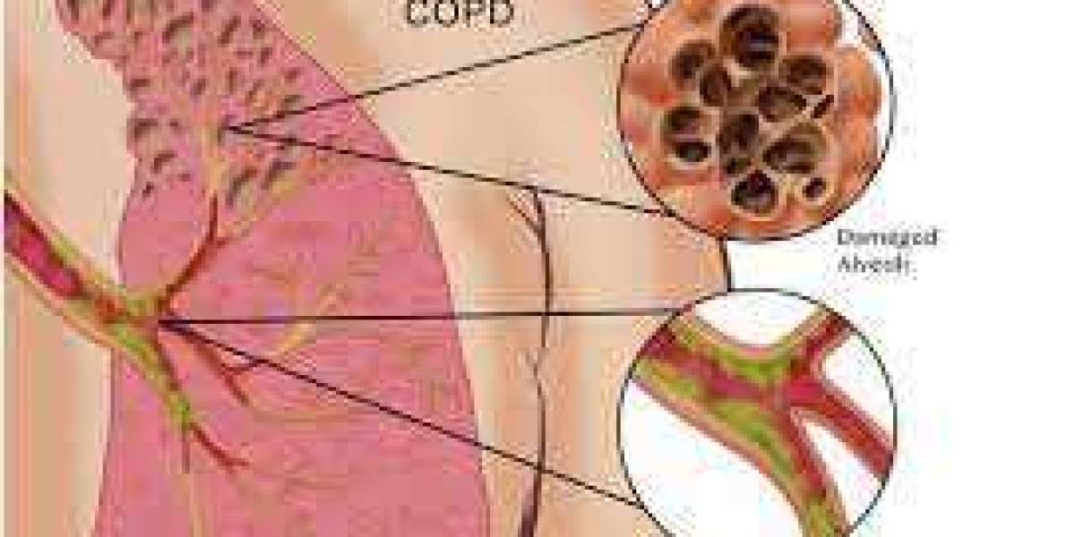 Nurturing Elderly Lungs: Dr. J.K. Samaria’s Holistic Care as a COPD Doctor in Varanasi