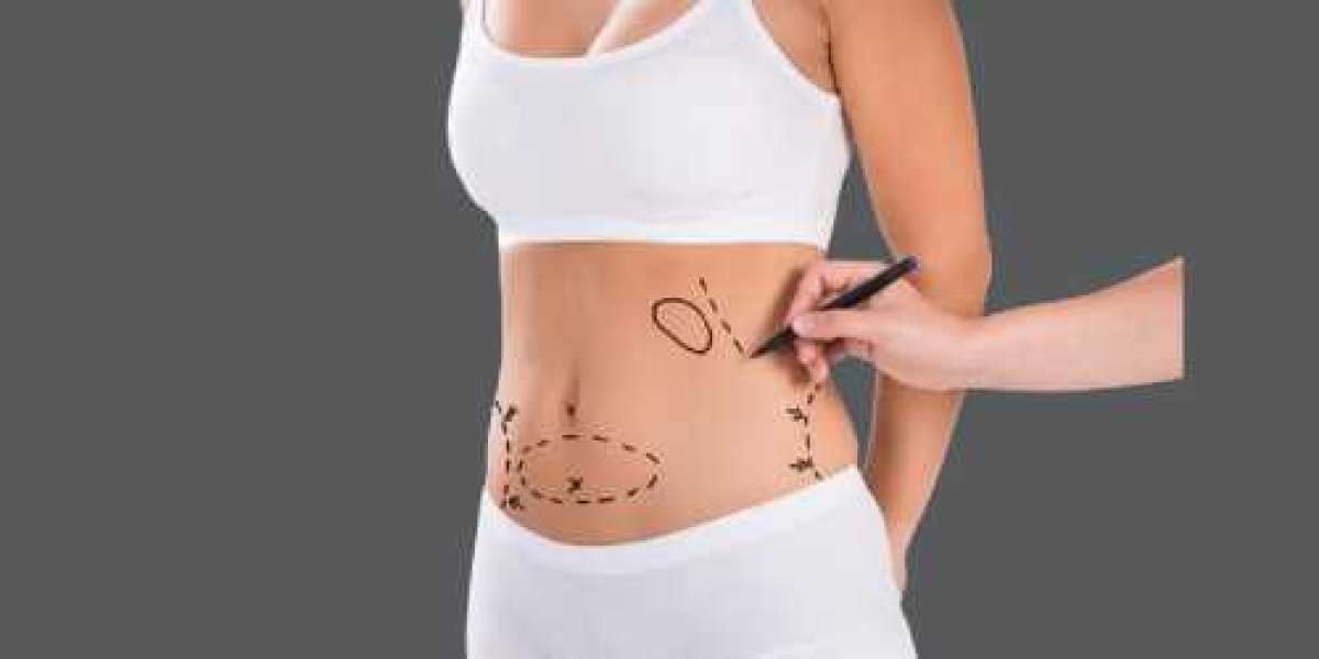 Liposuction in Dubai vs Non-Surgical Fat Reduction Which Is Better