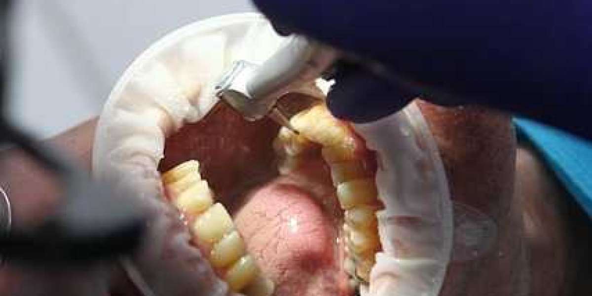 Emergency Dentist Sydney: What to Do When You Need Urgent Dental Care