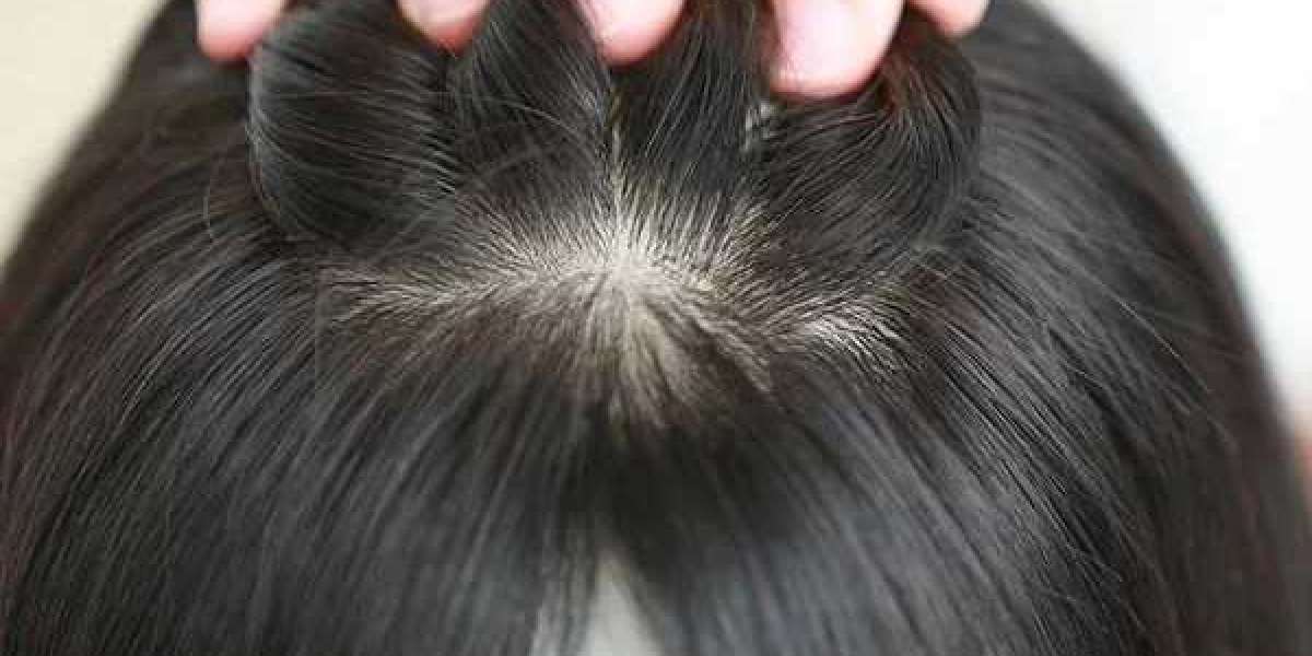Hair Patch for Women: A Non-Surgical Solution for Thicker, Fuller Hair