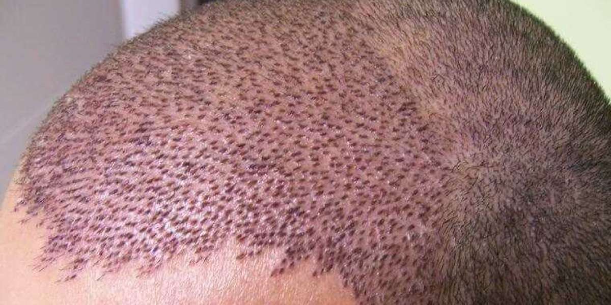 Why Hair Transplant Tourism is Growing Around the World