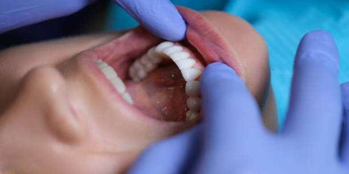 Garden Haven Dental in Melbourne can help you change your smile with composite veneers.