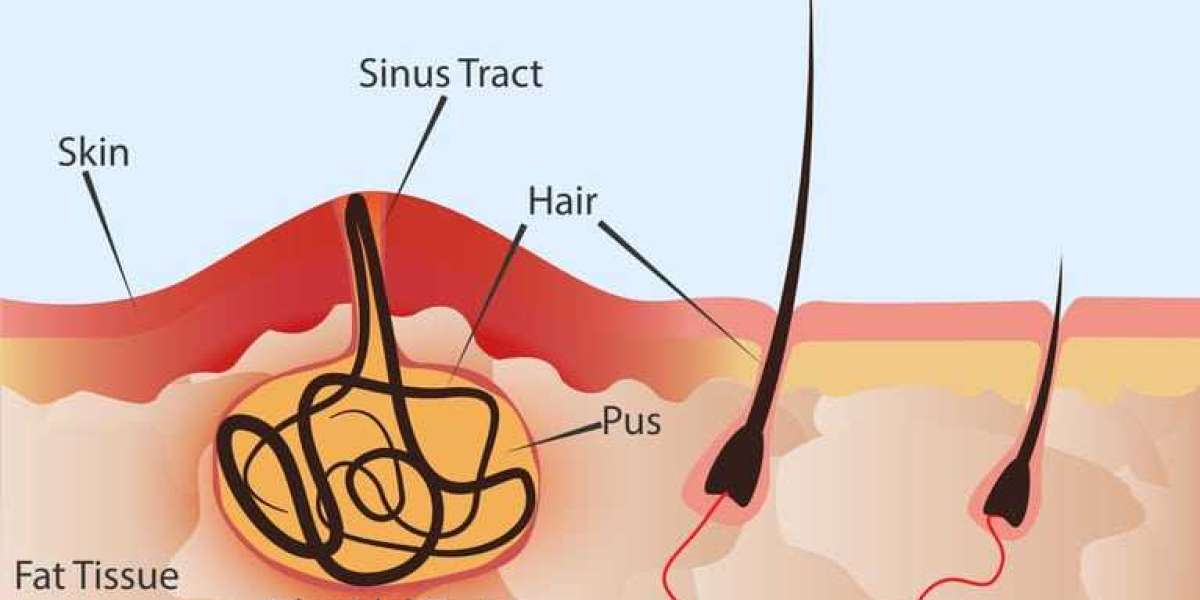 Exploring Surgical Options for Pilonidal Cyst Removal: What You Need to Know