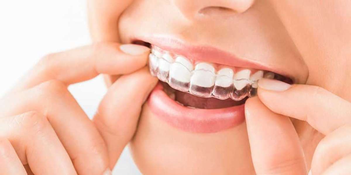 Why Clear Aligners Are the Modern Choice