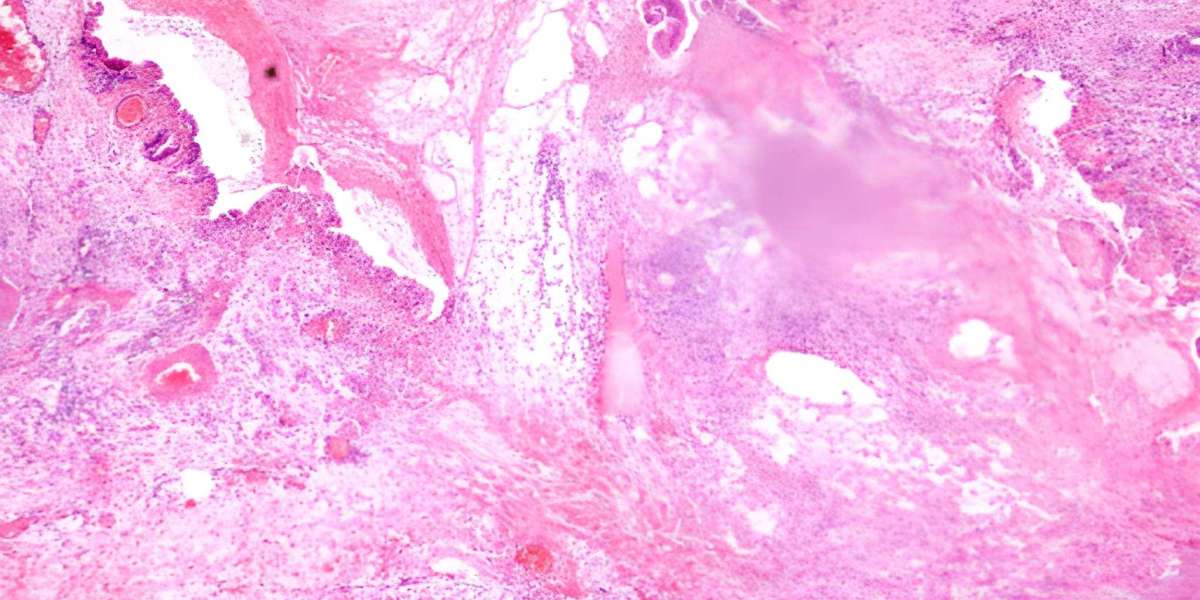 Innovations in B‐Rapidly Accelerated Fibrosarcoma Therapy: Market Dynamics and Future Outlook