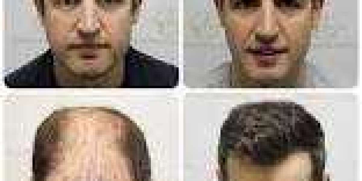 Hair Transplant London, UK - Westminster Medical Group