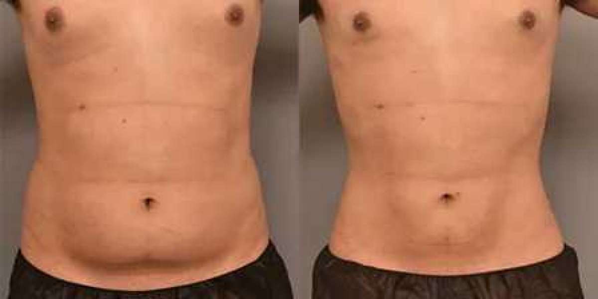Reshape Your Confidence with Liposuction in Islamabad