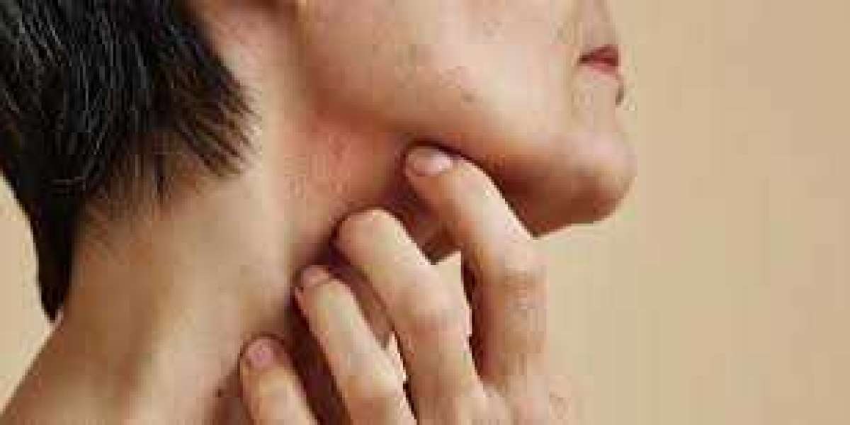 OCD and Dermatillomania, Dermatillomania Treatment: Effective Strategies for Managing Skin-Picking Disorder