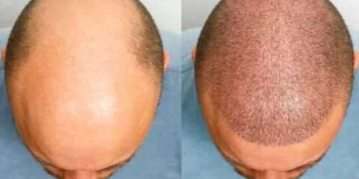 Hair Transplant in Islamabad: Modern Solutions for Natural Hair Growth
