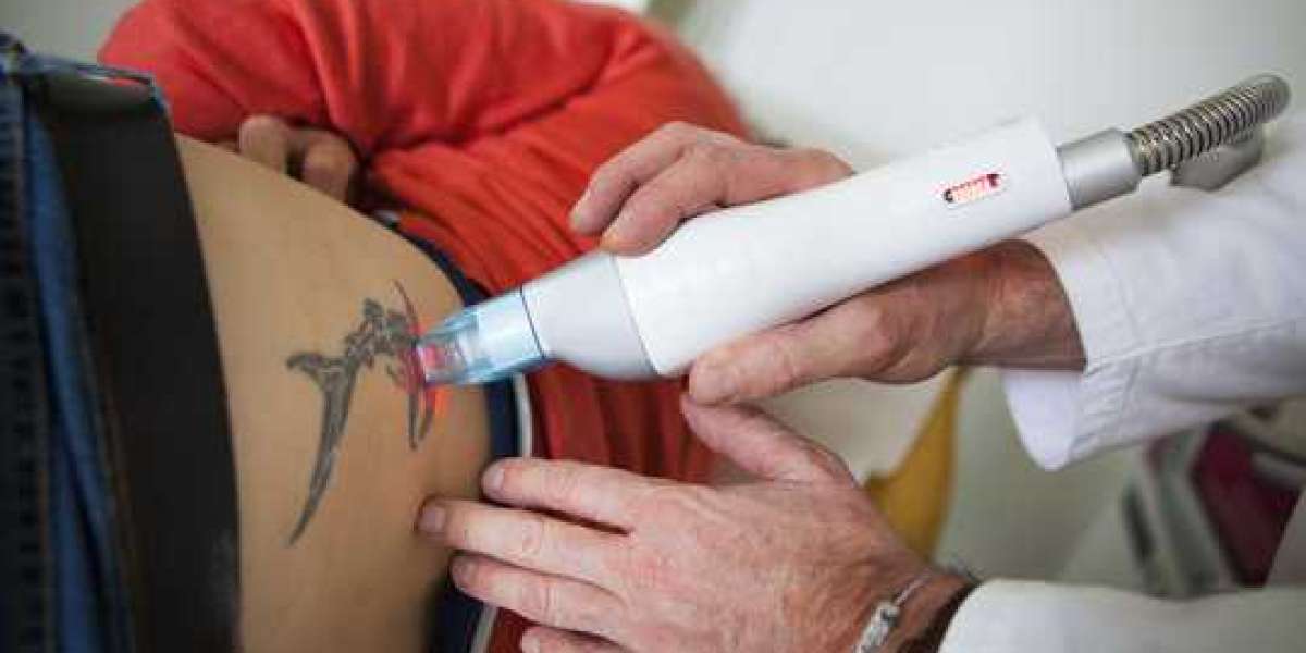 Regain Clear Skin with Laser Tattoo Removal Treatment in Islamabad