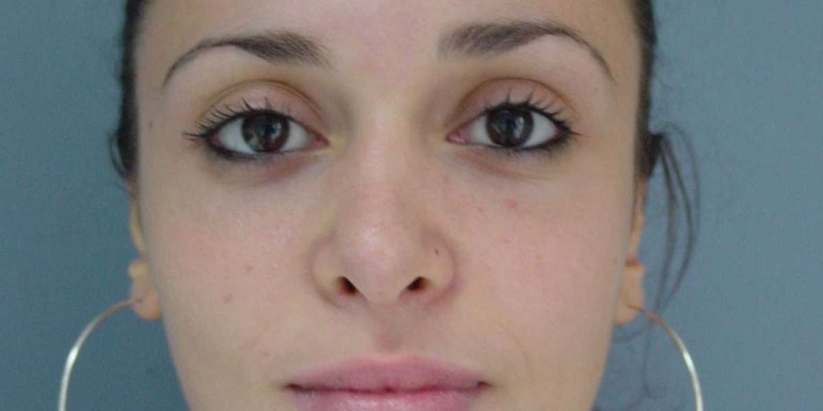 Surgery Before and After Photo Gallery Center for Aesthetic Artistry